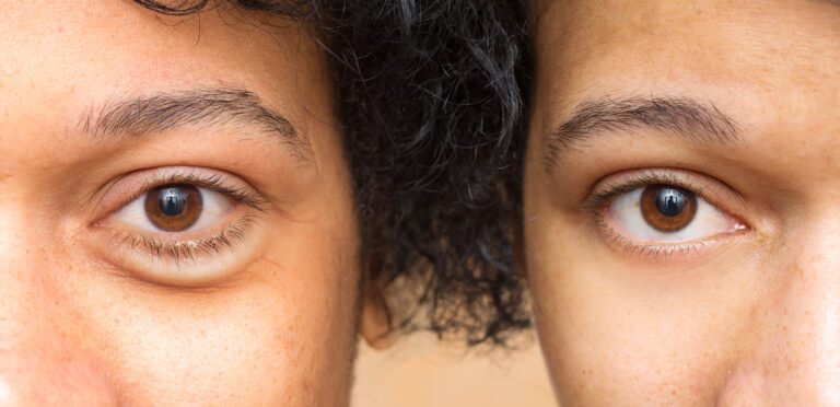 Eyes of woman before and after cosmetic treatment