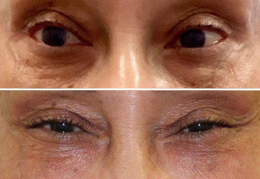 Lower-Eyelid-Before-and-After-4