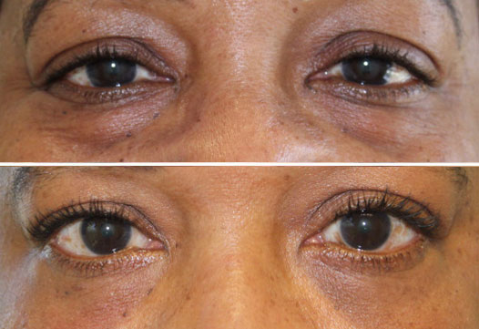 Lower Eyelid Surgery in Reading PA