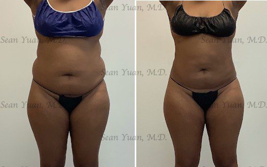 liposuction of abdomen and lovehandle before and after