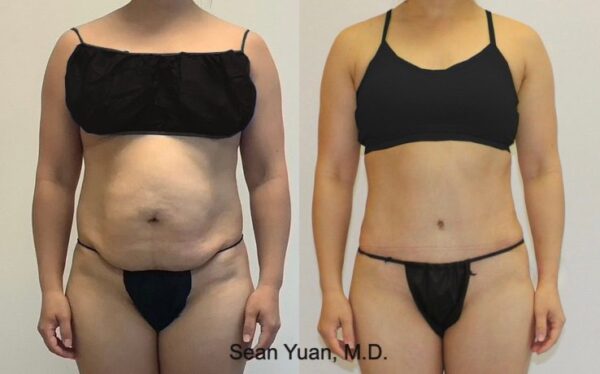 tummy tuck surgery in Reading PA