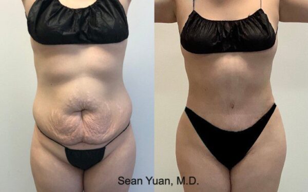 tummy tuck before and after