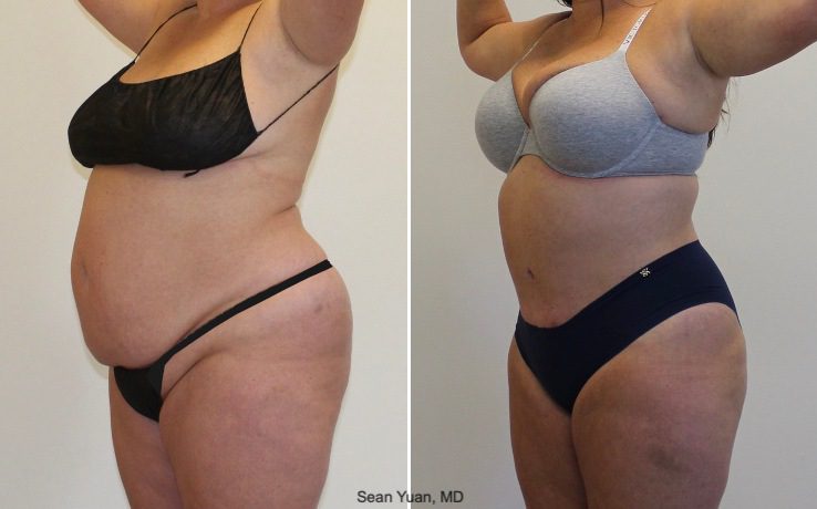 Tummy Tuck Before & After 3a