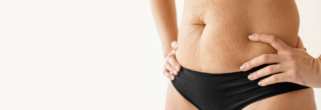 Awake tummy tuck abdominoplasty by Dr. Yuan