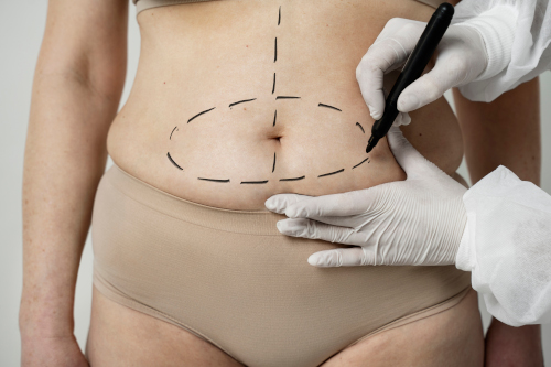 Cosmetic liposuction treatment concept for patients in the King of Prussia area