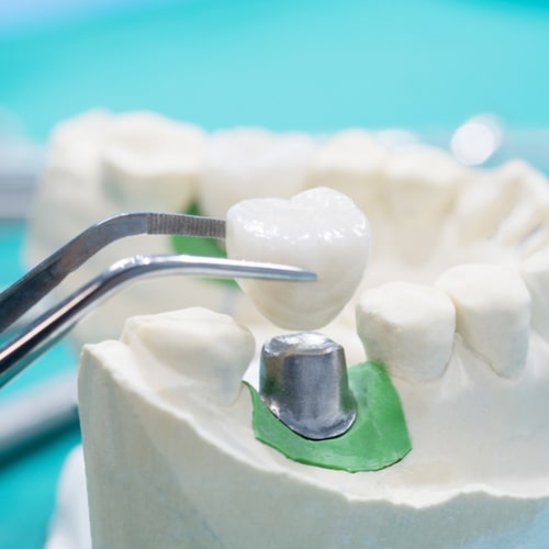 tooth support fix bridge implan