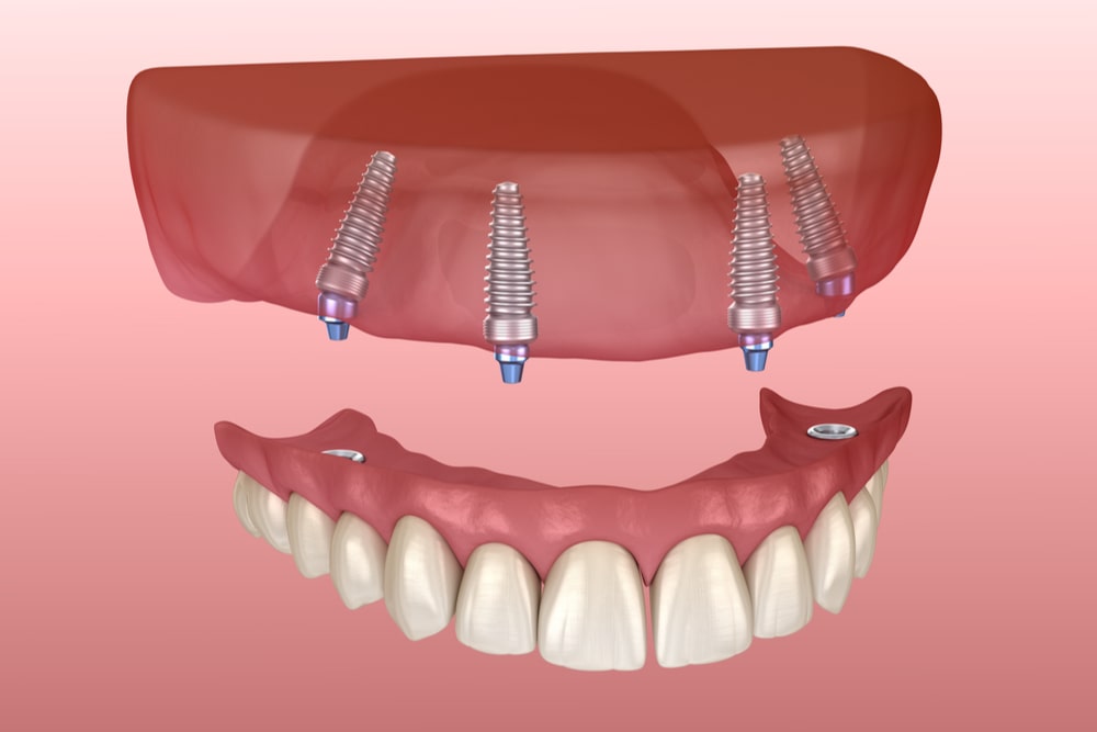 Maxillary prosthesis with gum All on 4 system