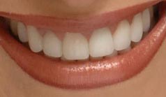 49 year old female with 20 existing porcelain veneers