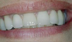 49 year old female with 20 existing porcelain veneers