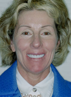 49 year old female with 20 existing porcelain veneers