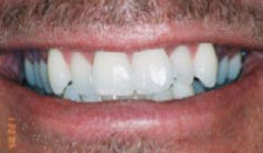 30 year old male with history of crooked before dental treatment