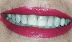 57 year old female with dark, tetracycline stained teeth