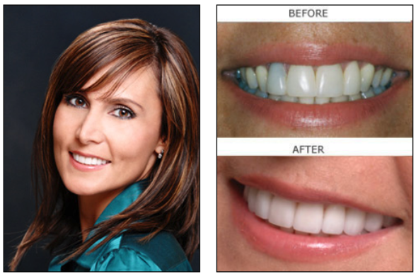 Porcelain Veneers before and after