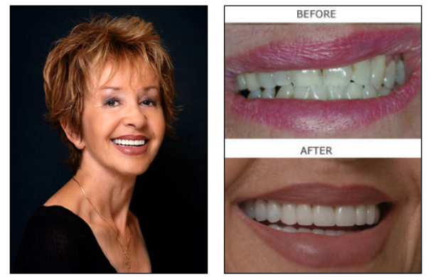 Porcelain Veneers before and after