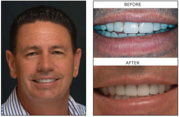 Full Mouth Reconstruction before and after