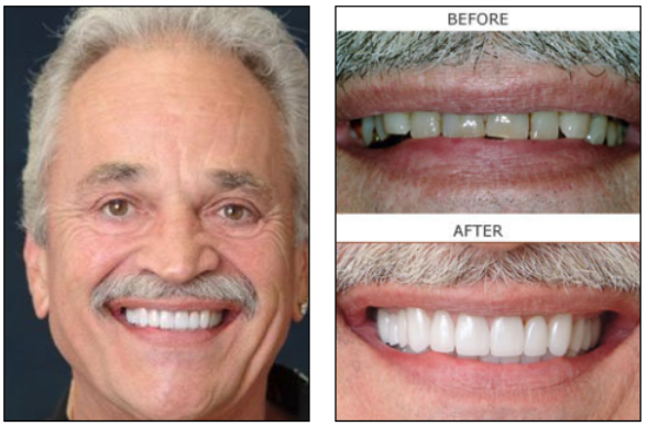 Full Mouth Reconstruction before and after