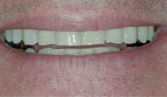 46 year old male presents with unsightly before dental treatment