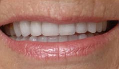 81 year old female with old, worn unsightly restorations