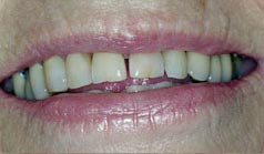 81 year old female with old, worn unsightly restorations