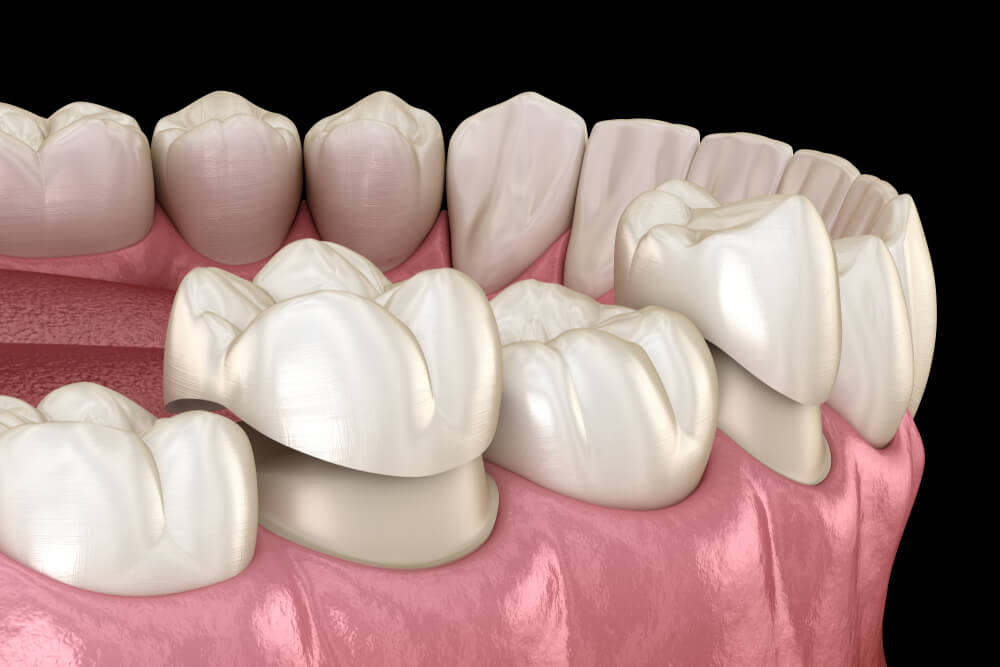 Porcelain crowns placement over premolar and molar teeth