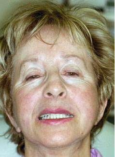 71 year old female presents with old, discolored before dental treatment