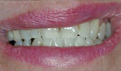 71 year old female presents with old, discolored before dental treatment