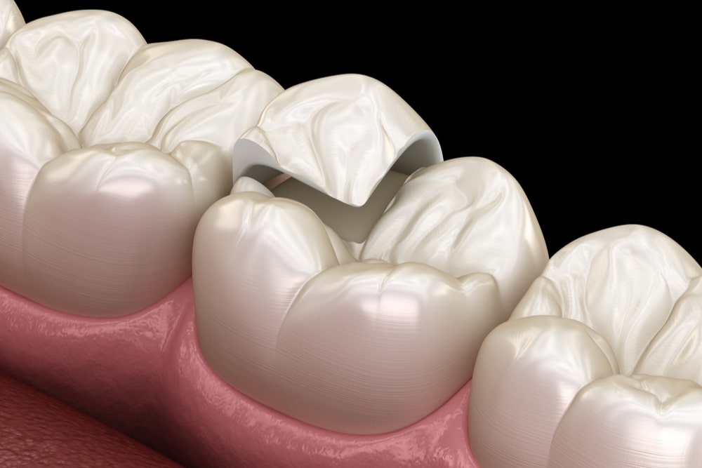 Onlay ceramic crown fixation over tooth