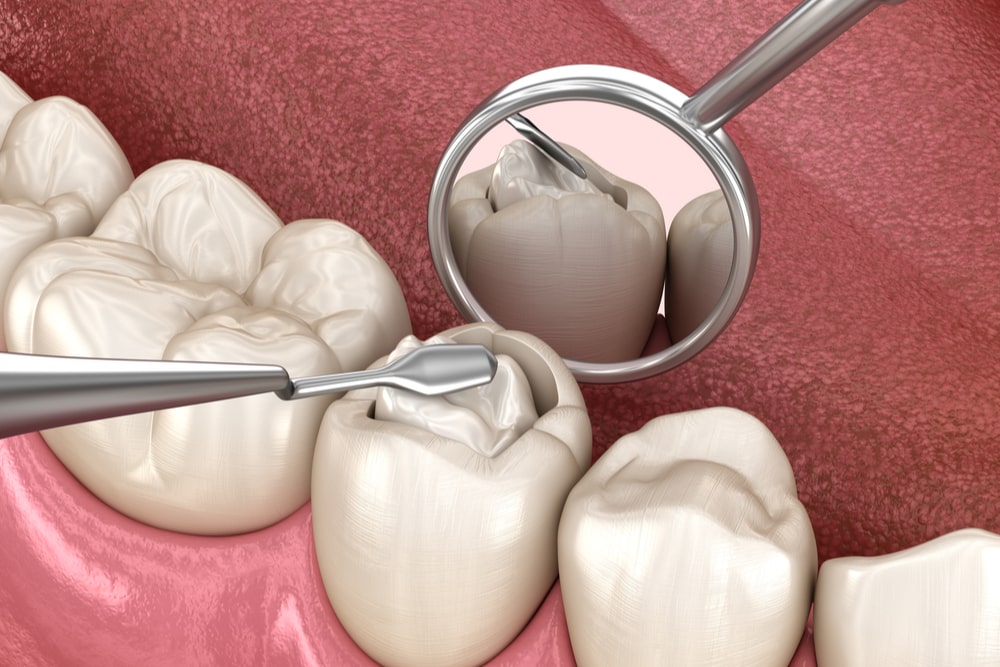 Decayed tooth restoration with composite filling