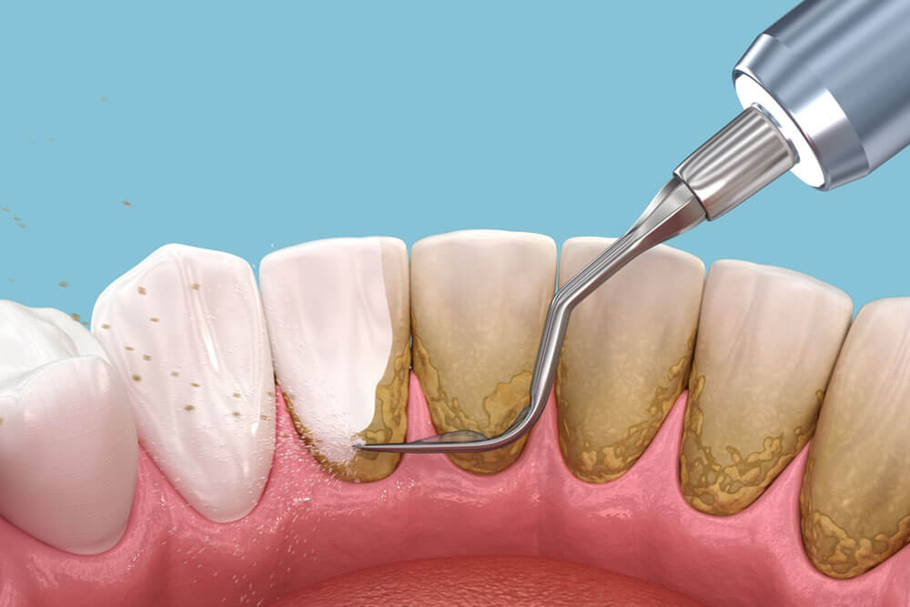 Scaling and root planing (conventional periodontal therapy)