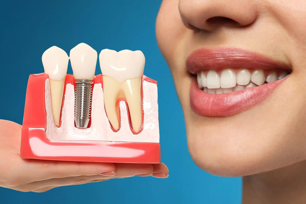 Young woman with beautiful smile and dentist holding educational model of dental implant on blue background, closeup