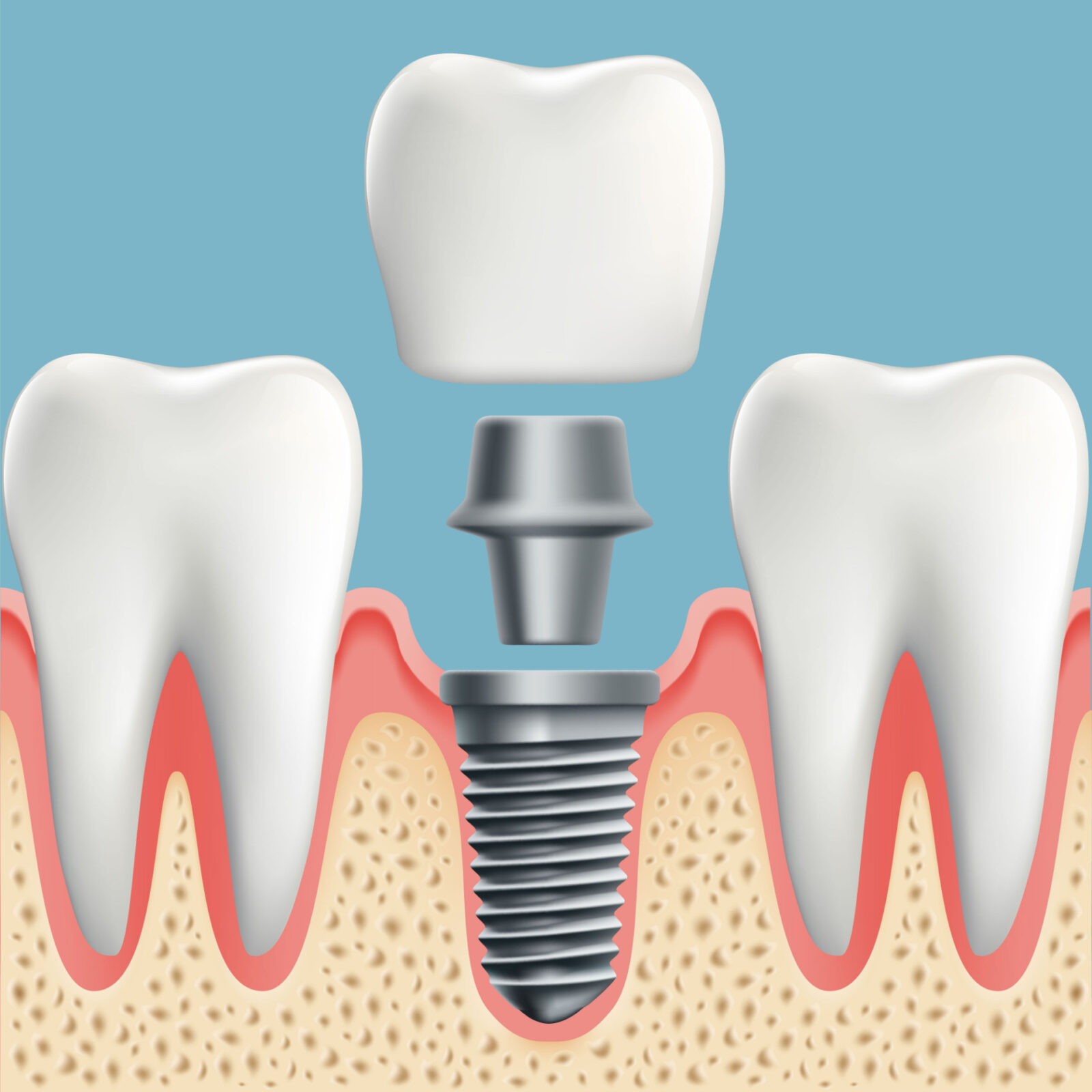 An illustration example of Dental Implants