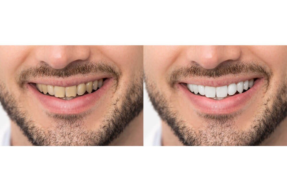 Transform Your Teeth with Clear Aligners: Before and After Pictures