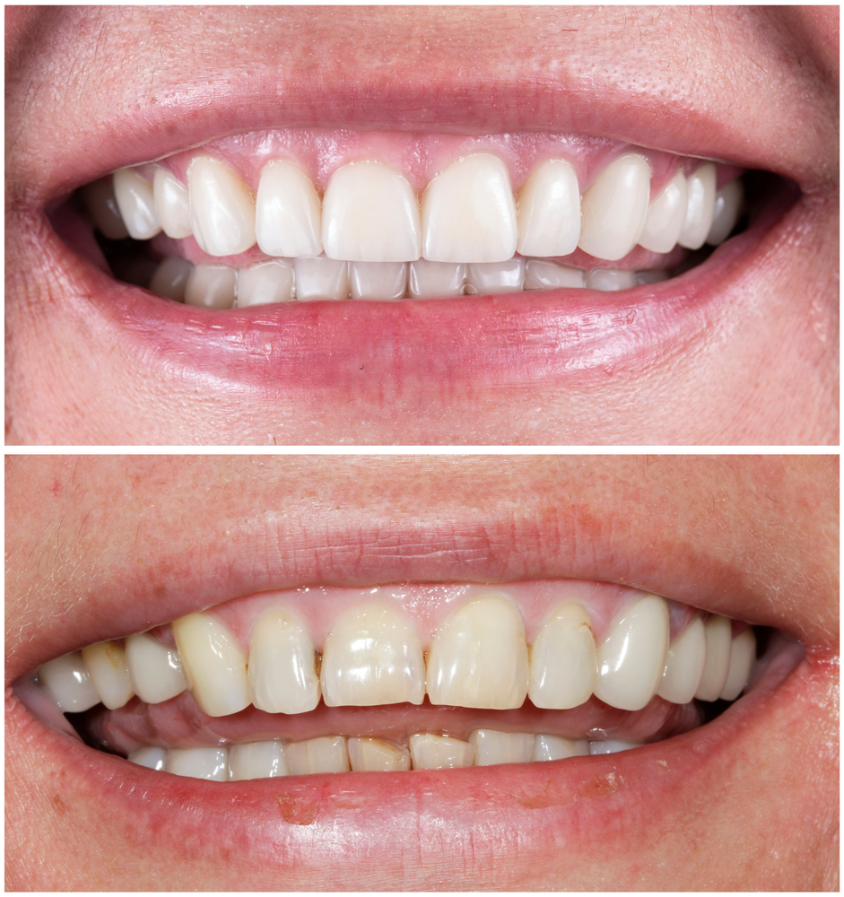 A before and after of Veneers