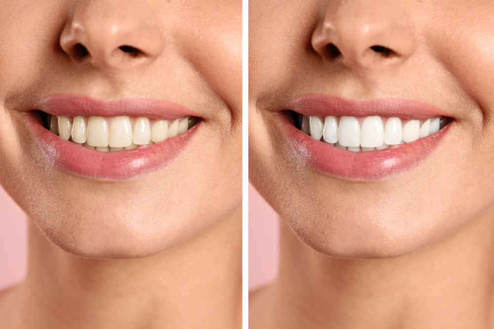 An example of Teeth Whitening before and after