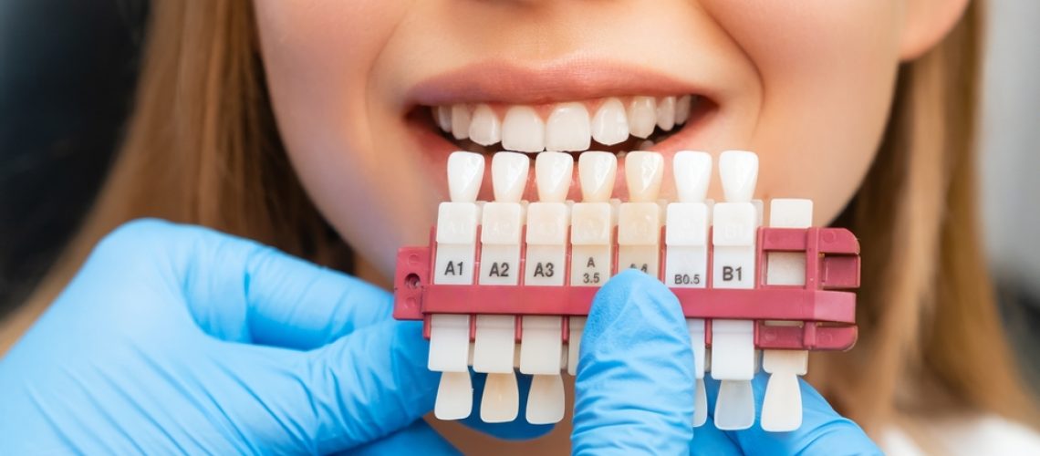 Crowns vs. Veneers: Which Is Right For You?