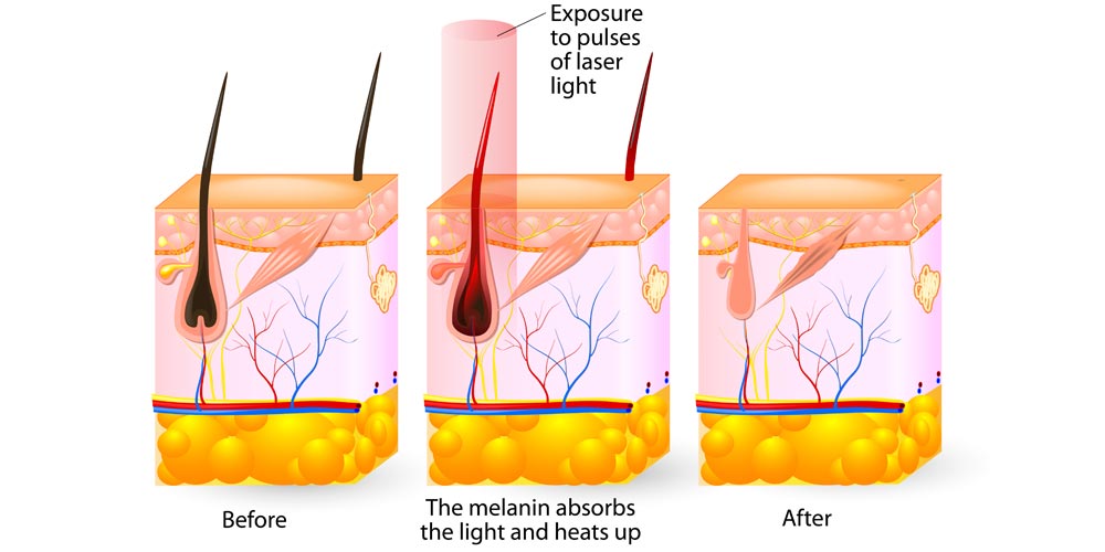 Removes Hair Without Skin Irritation Art concept