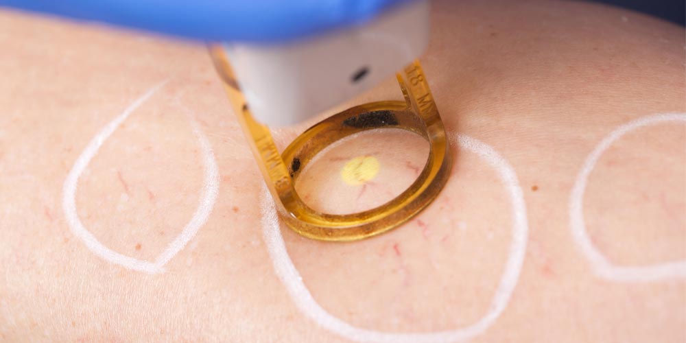 Laser Spider Vein Treatment