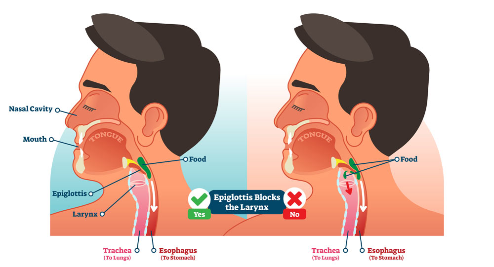 Vector illustration about dysphagia and the different parts of the throat
