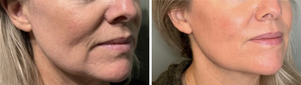 A before and after of Virtue RF Microneedling