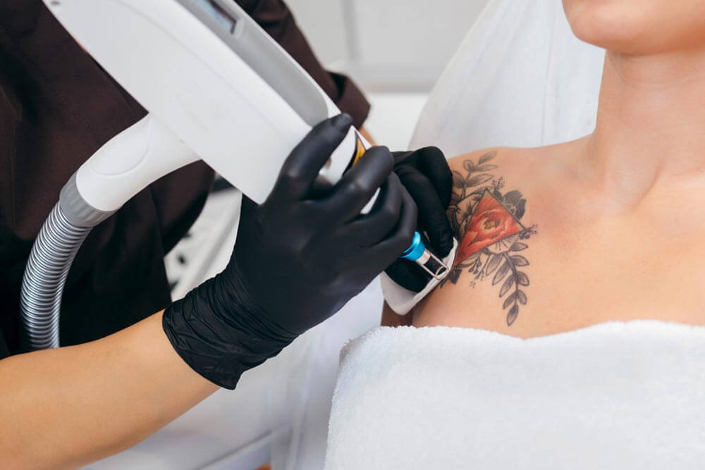 Laser tattoo removal from shoulder