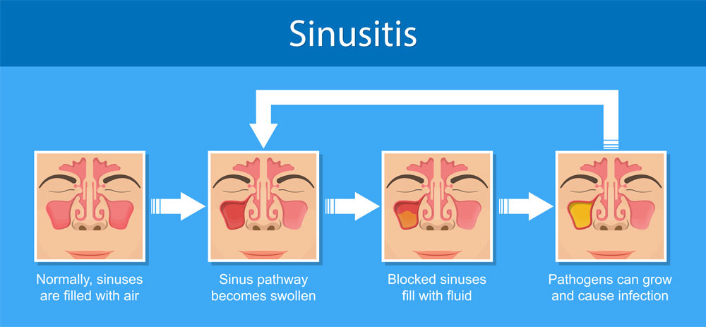Sinusitis medical disease before Balloon Sinuplasty