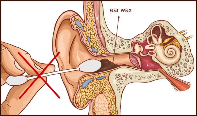 Earwax build up inside ear