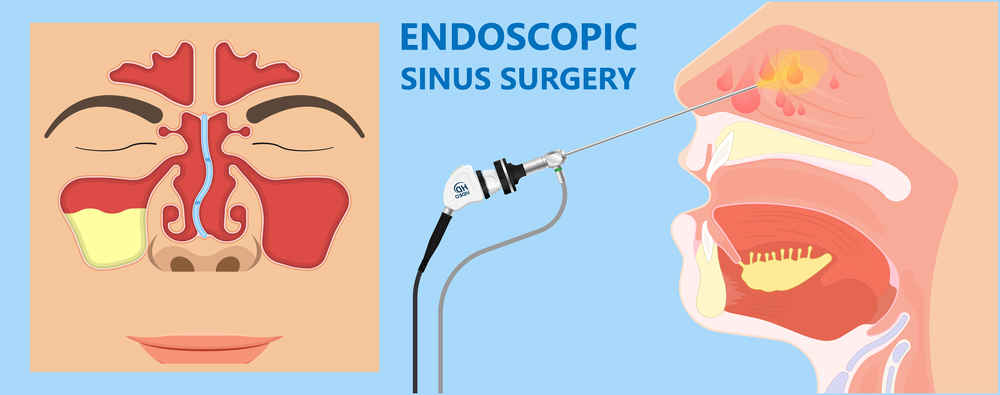 endoscopic sinus surgery. art concept