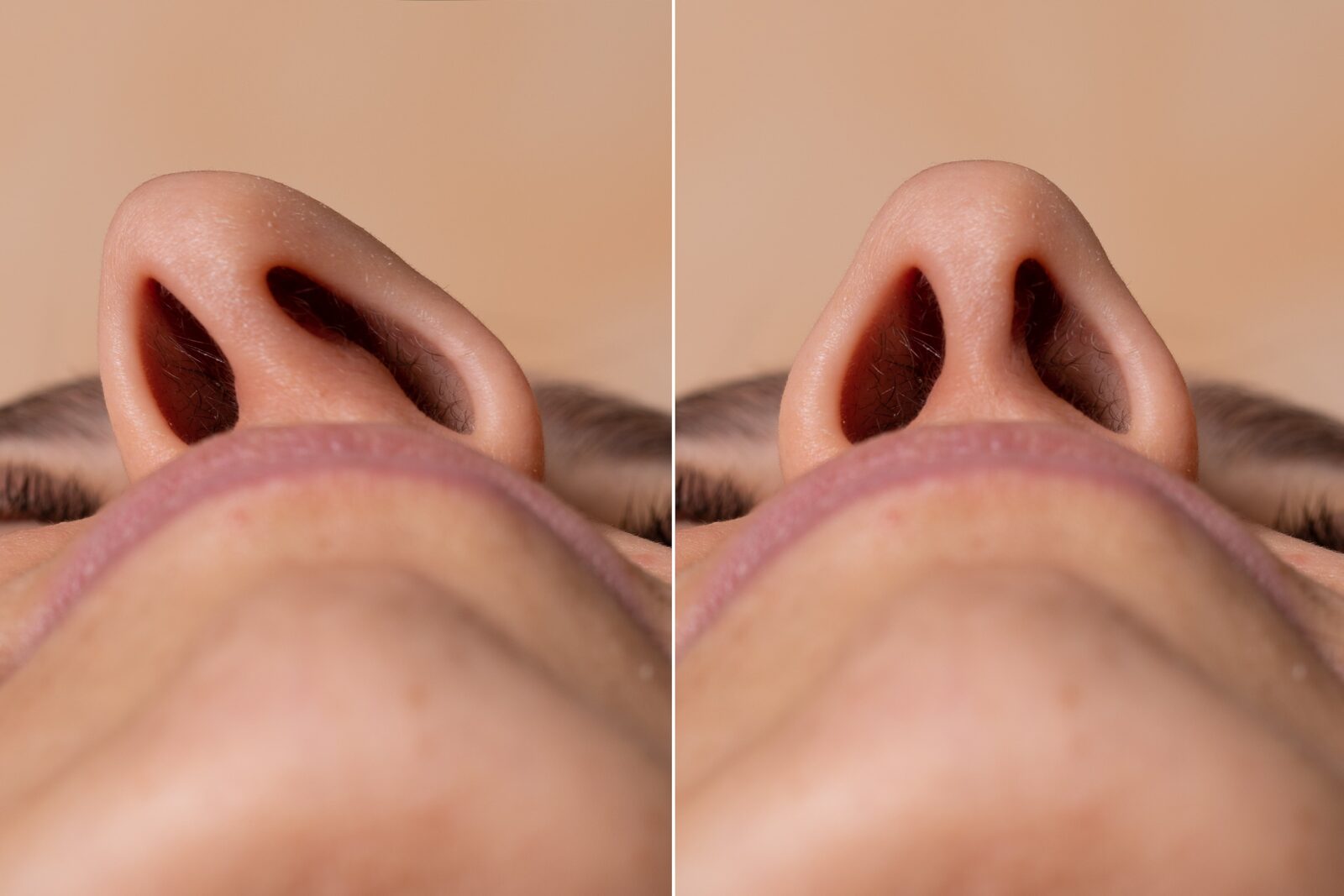 nostrils before and after rhinoplasty