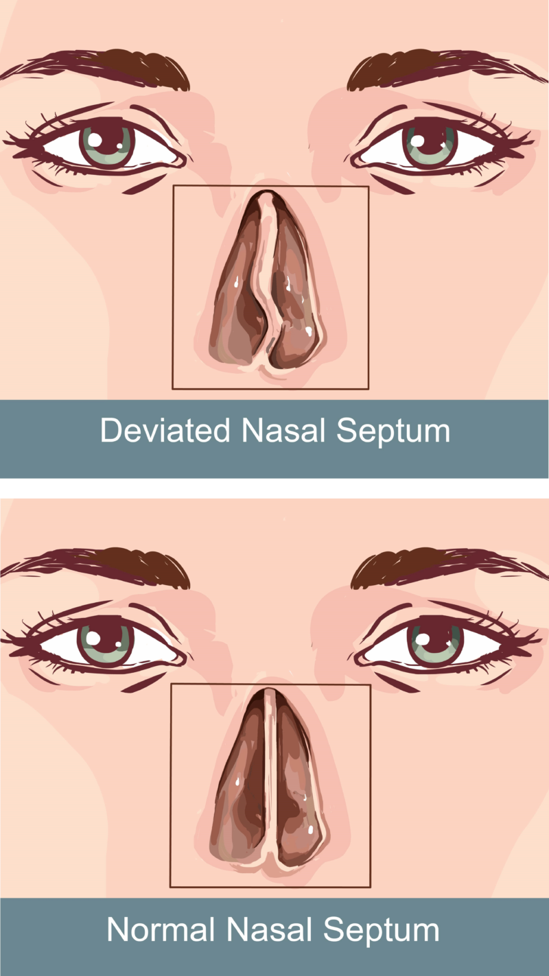 Septor Rhinolasty What is a Septorhinoplasty? | Annapolis and Severna Park, MD