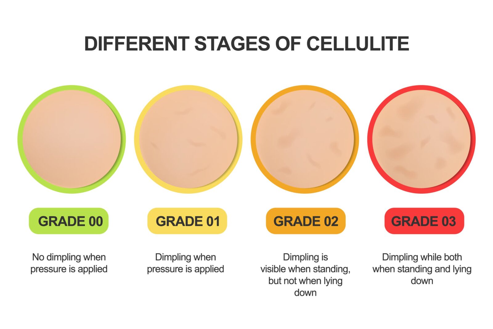 stages of cellulite