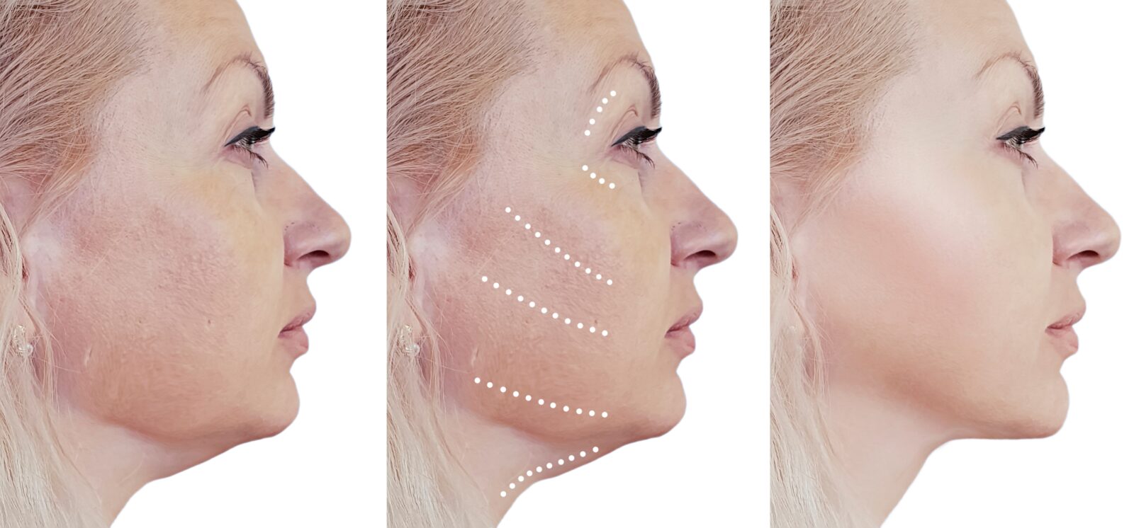 before and after facelift