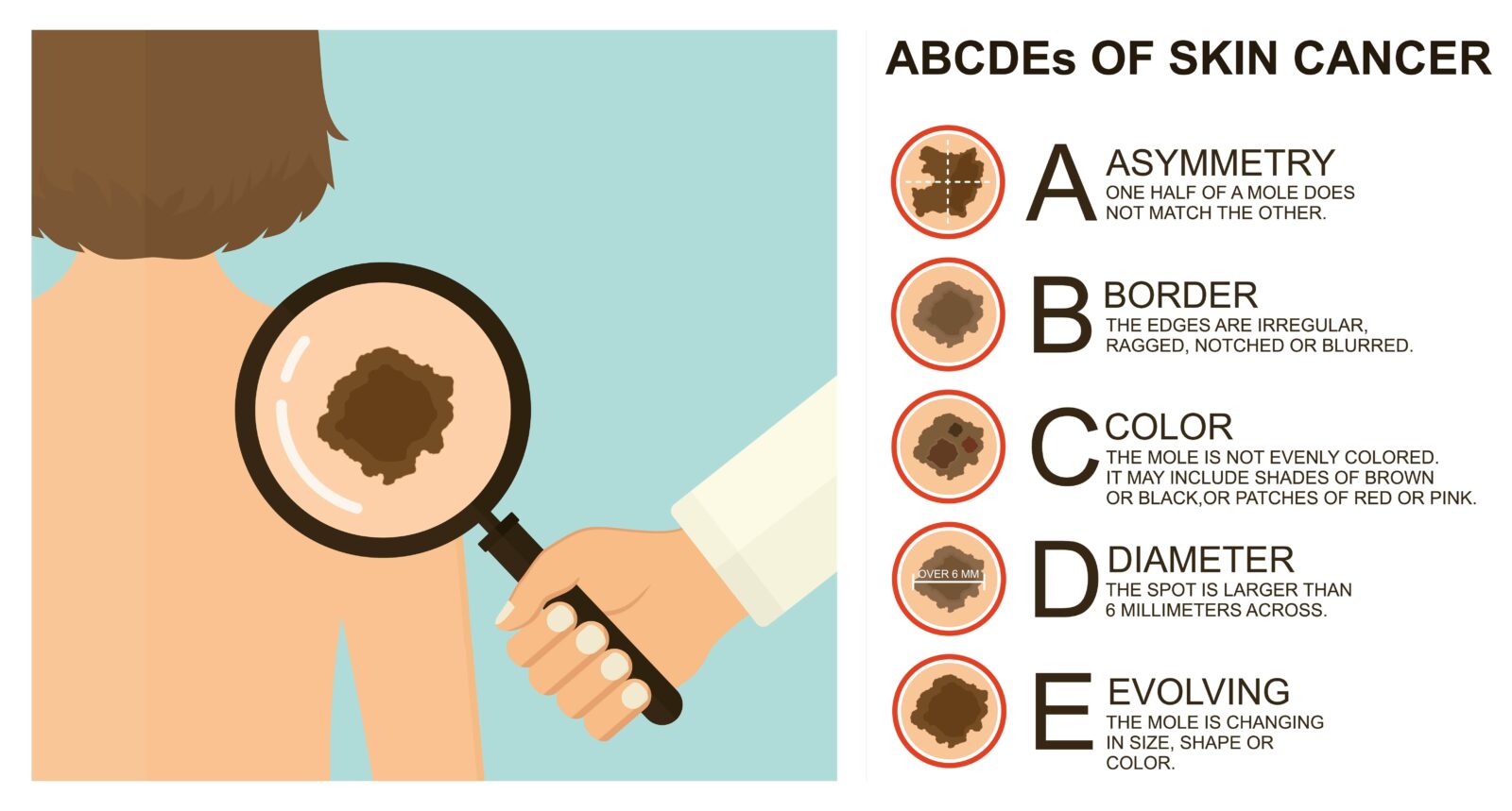 ABCDEs of Melanoma