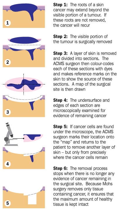 description of Mohs Surgery