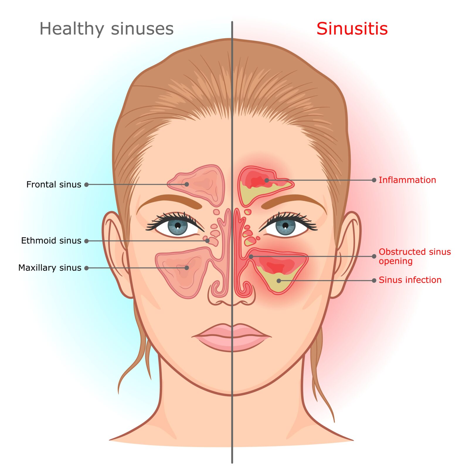 healthy sinuses vs. sinusitis